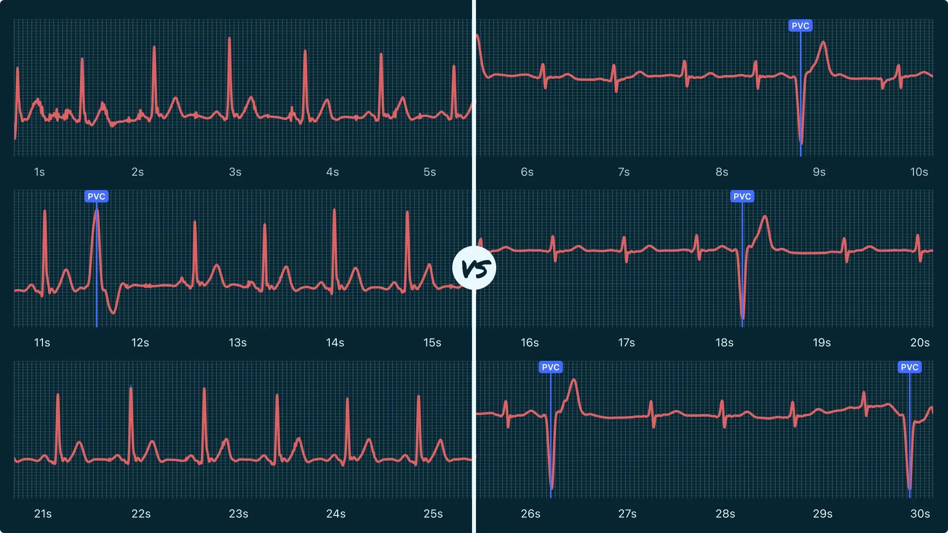 Premature Ventricular Contraction (Single) Vs. Premature Ventricular